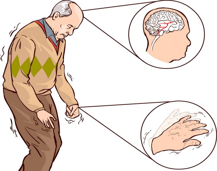 Parkinson Hastalığı: Nedenleri, Belirtileri ve Günlük Yaşamda Yönetimi